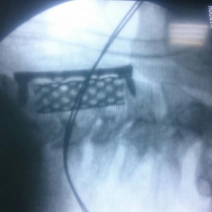 SENTINUS, Mesh Cage pentru corpectomie