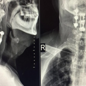 Sistem fixare posterior din Titan (suruburi poliaxiale, posterioare cervicale , AP Trauma si Oncologie / Tumori)