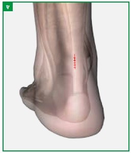Achillon, solutie minim-invaziva pentru rupturile de tendon Ahile