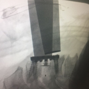 AURA, Suruburi fixare placa cervicala ( AP Trauma)