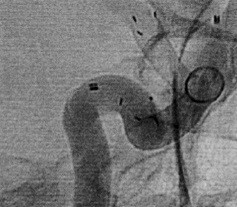 DERIVO, dispozitiv de ebmolizare (Flow Diverter) tratarea anevrismului intracran