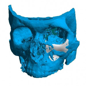 Placa (Cranioplastie), defecte BMF