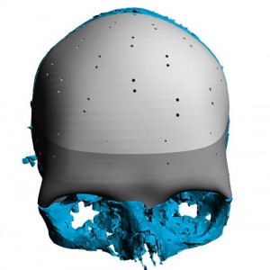 Placa (Cranioplastie), defecte craniene