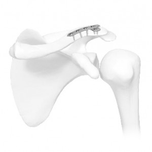 Placa de Clavicula acromioclaviculara
