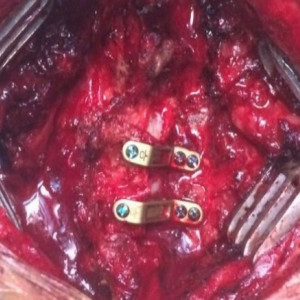 ULTIO, Placa Cervicala laminoplastie