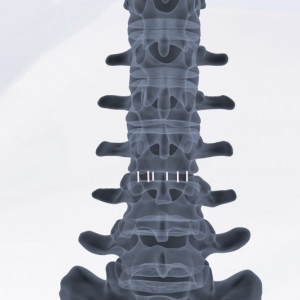 ZELOS, Cage vertebral lombar posterior din PEEK Plif