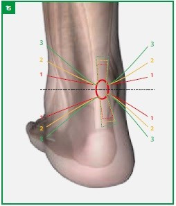 Achillon, solutie minim-invaziva pentru rupturile de tendon Ahile