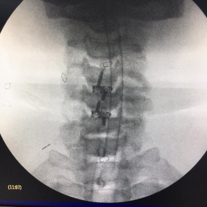 TITANOPEEK - Cage Vertebral Cervical cu suruburi de prindere si profil anatomic