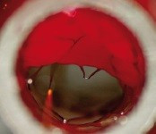 APERIO, Stent Trombectomie Mecanica ( pentru eliminarea cheagurilor, trombilor din sange)