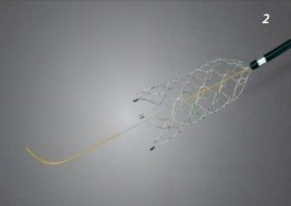 CREDO, Stent flexibil din Nitinol cu ​​auto-expandare pentru tratamentul stenozei intracraniene