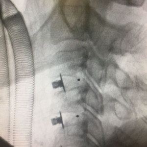 EOS Hybrid, Cage Vertebral cervical din PEEK