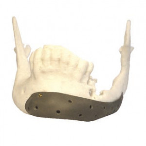 Implant mandibula Titan PSI Enlife Solutions