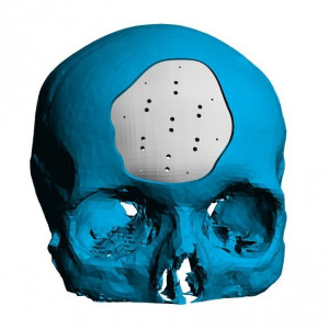 Placa (Cranioplastie), defecte craniene
