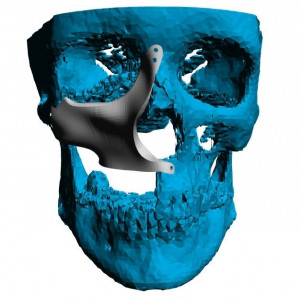 Placa (Cranioplastie), defecte ORL