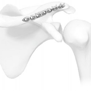 Placa de Clavicula in S