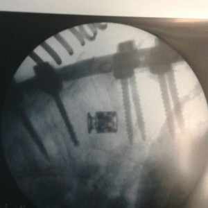 X si XP , cage corpectomie din Titan ( AP Trauma si Oncologie / Tumori)