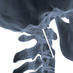 ATLAS, Suruburi canulate