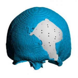 Placa (Cranioplastie), defecte craniene