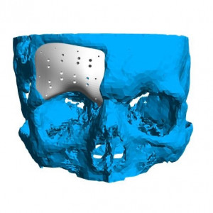 Placa (Cranioplastie), defecte ORL