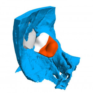 Placa (Cranioplastie), defecte ORL