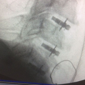 ARION, Cage Vertebral cervical expandabil