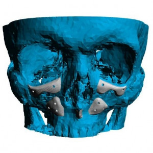 Placa (Cranioplastie), defecte BMF