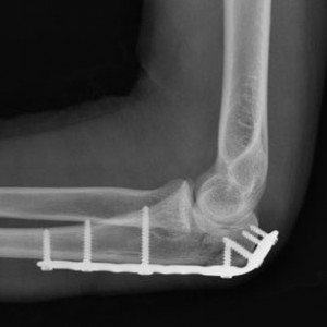 Placa Humerus Proximal poliaxiala pentru osteosinteza fracturii de Olecran