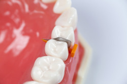 Pene plastic Fenderwedge